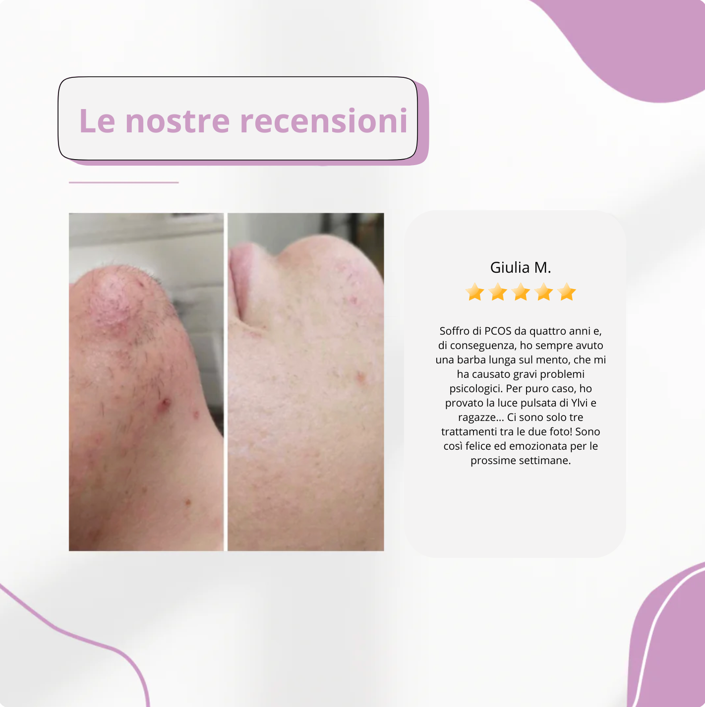 Epilatore IPL Elvys il miglior depilatore laser per uso domestico