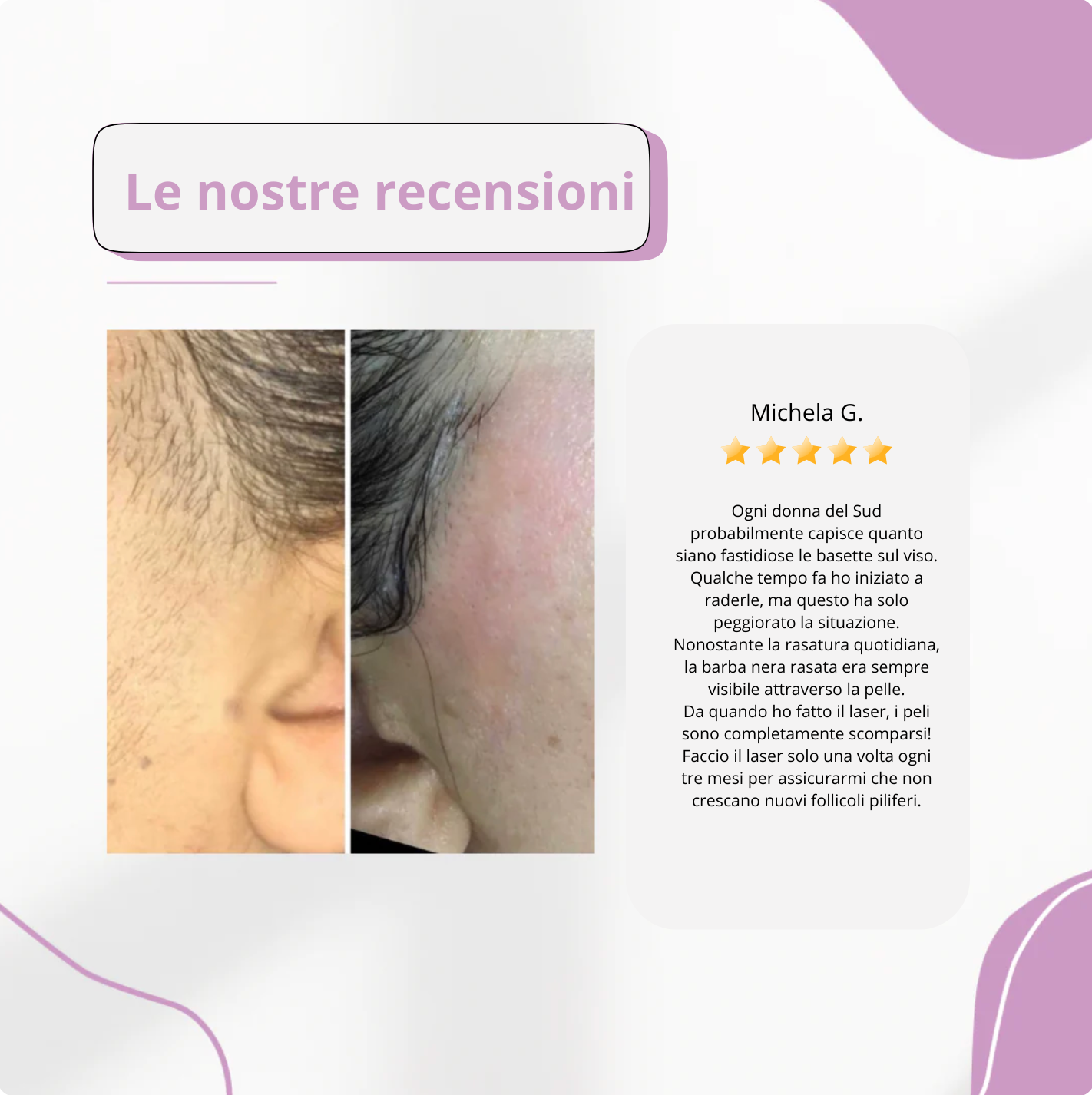 Epilatore IPL Elvys il miglior depilatore laser per uso domestico